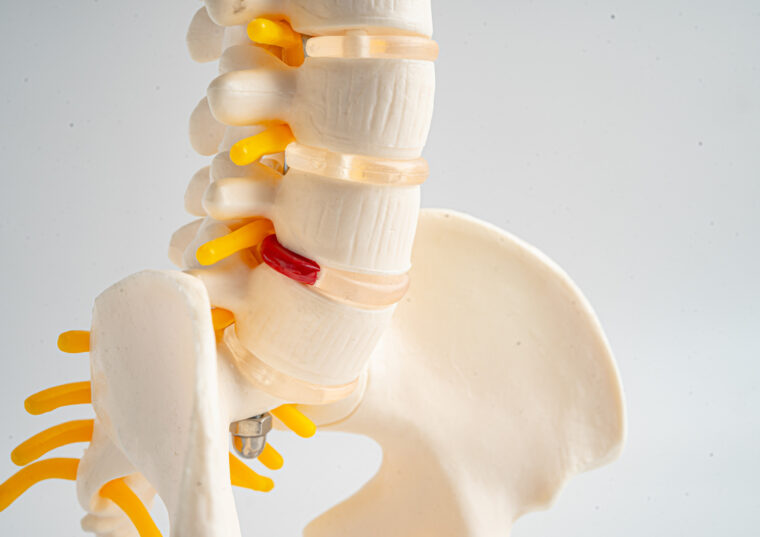 ヘルニアと言われた…整骨院に行っていいの？と迷っている方へ【河内長野市】